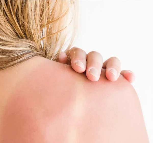 Close up of sunburned skin on shoulder.